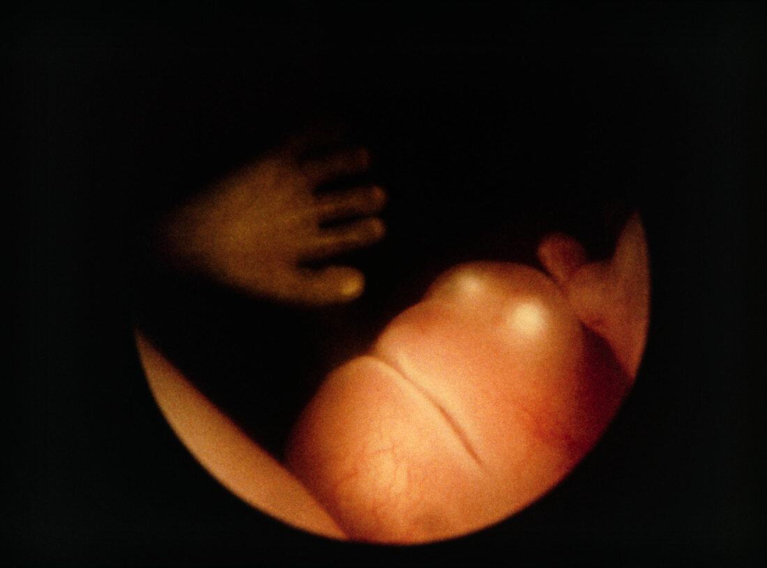 Endoscopic image of 10wk human foetus in situ