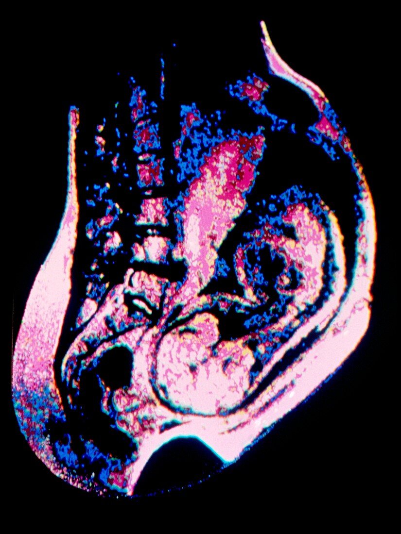 False-colour NMR scan of 8-month foetus in womb