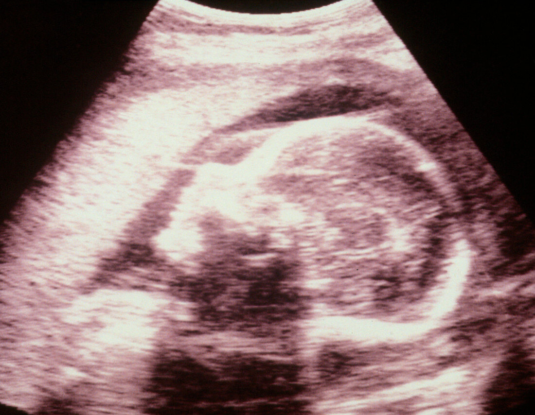 Tinted ultrasound scan of foetus at 25 weeks