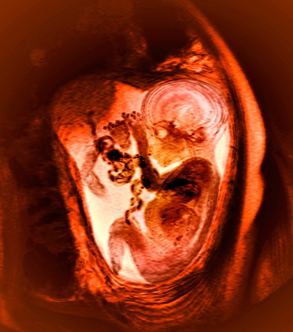 9 month foetus,MRI scan