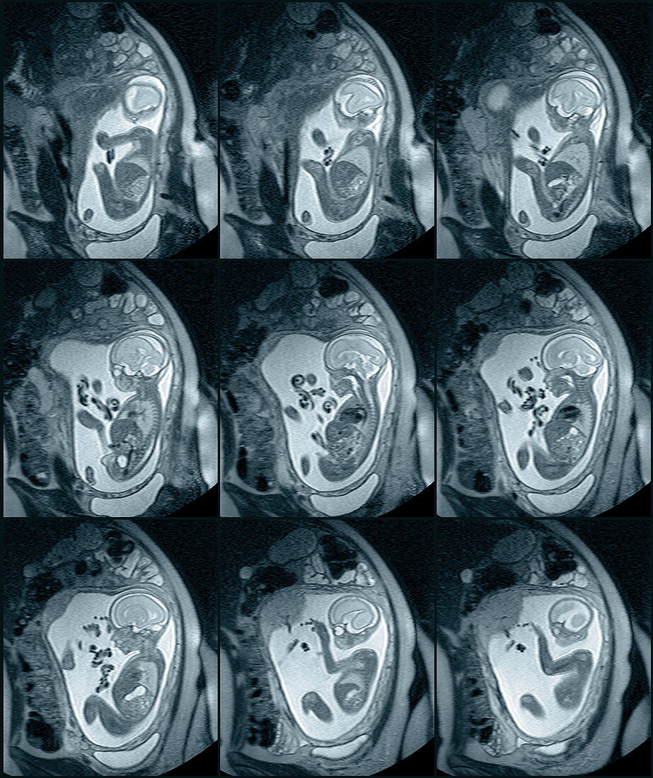 9 month foetus,MRI scans