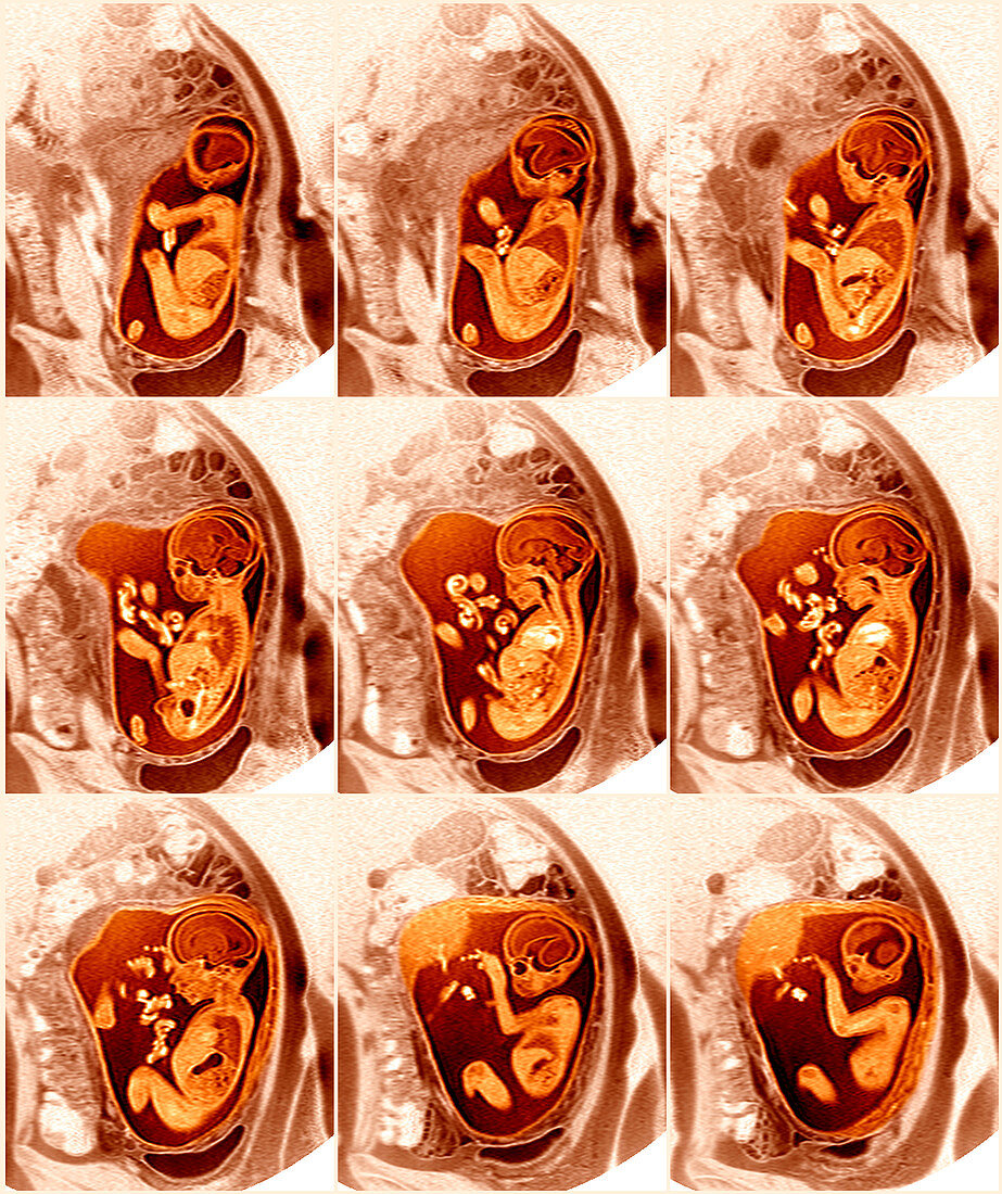 9 month foetus,MRI scans