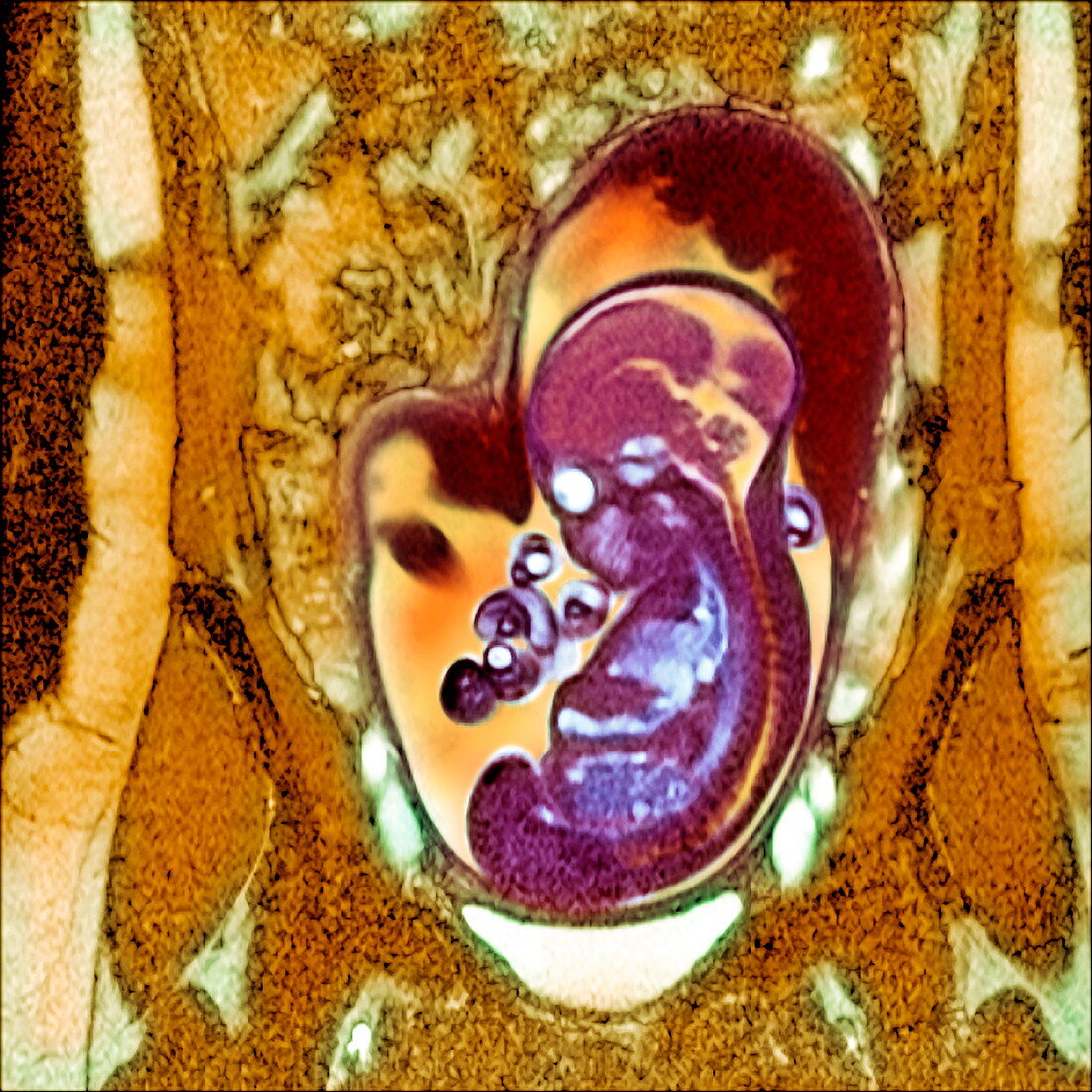 Abnormal foetus