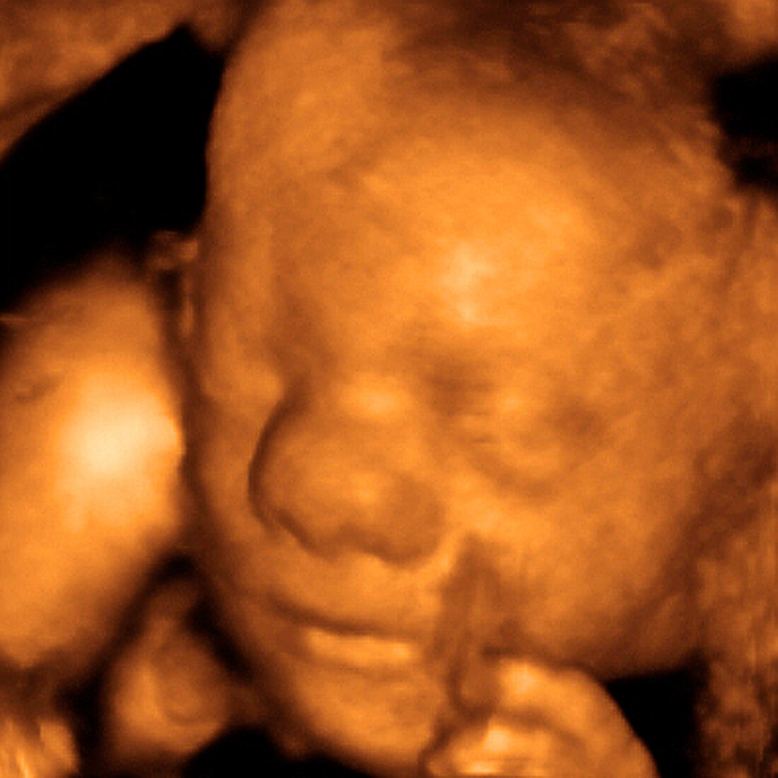 Foetus' face,3-D ultrasound scan