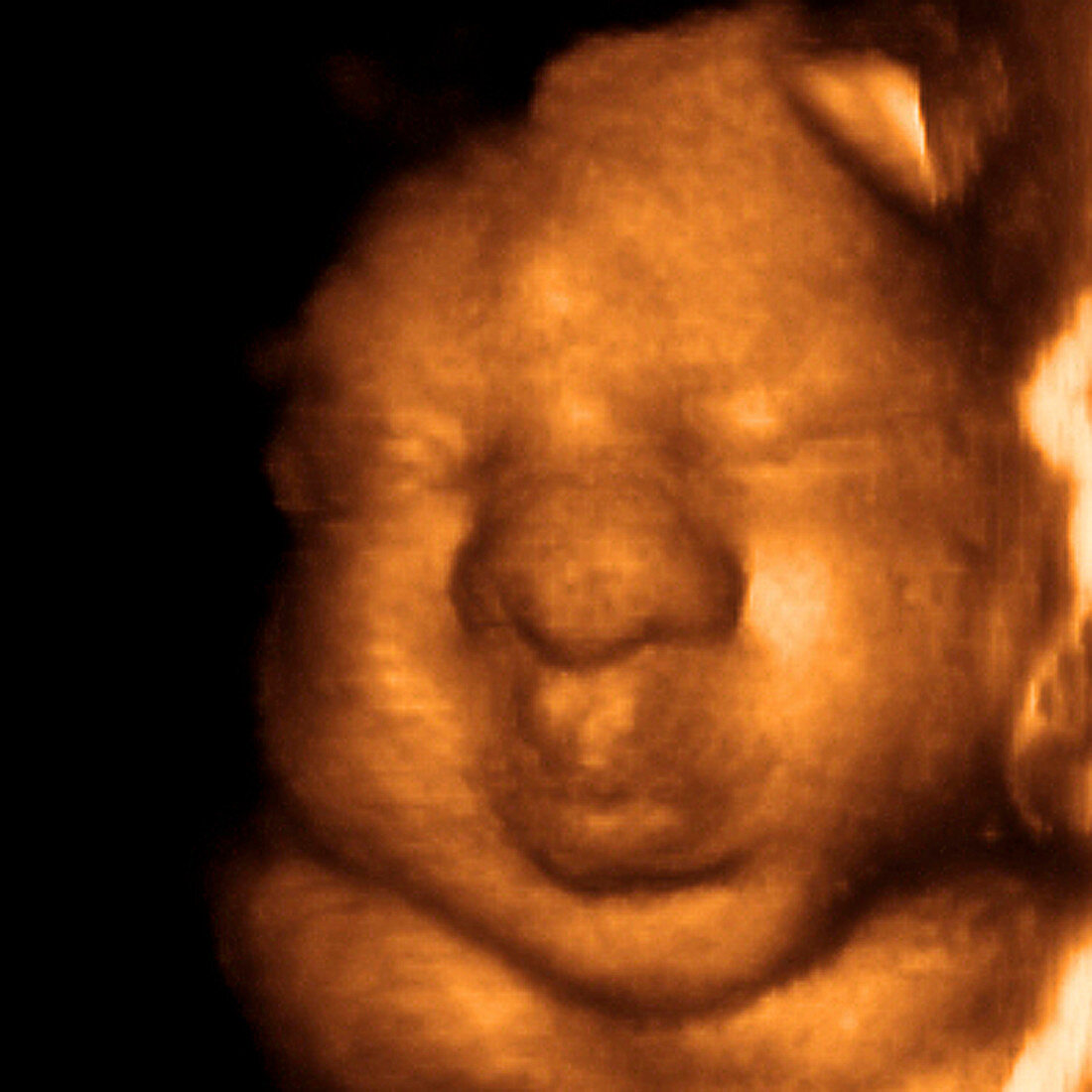 Foetus' face,3-D ultrasound scan