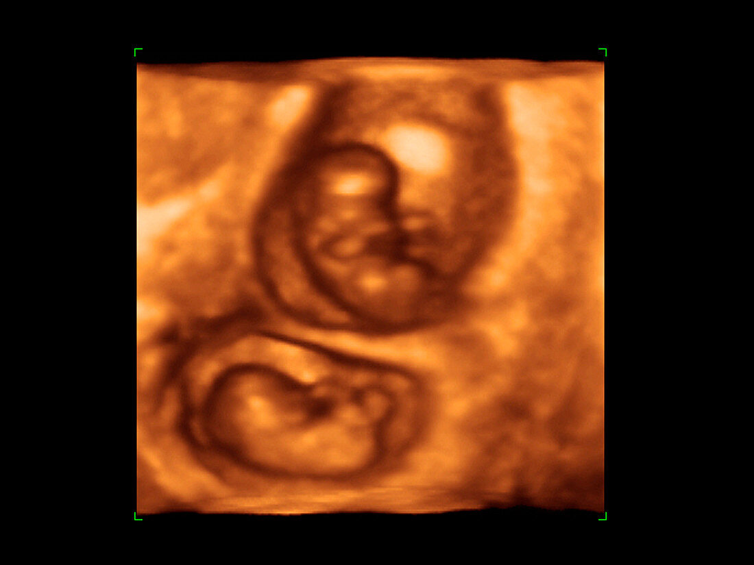 Twin foetuses,3-D ultrasound scan