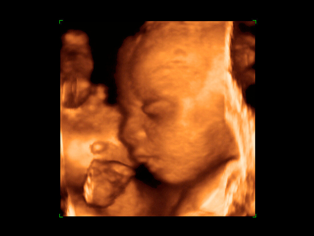 Foetus' face,3-D ultrasound scan