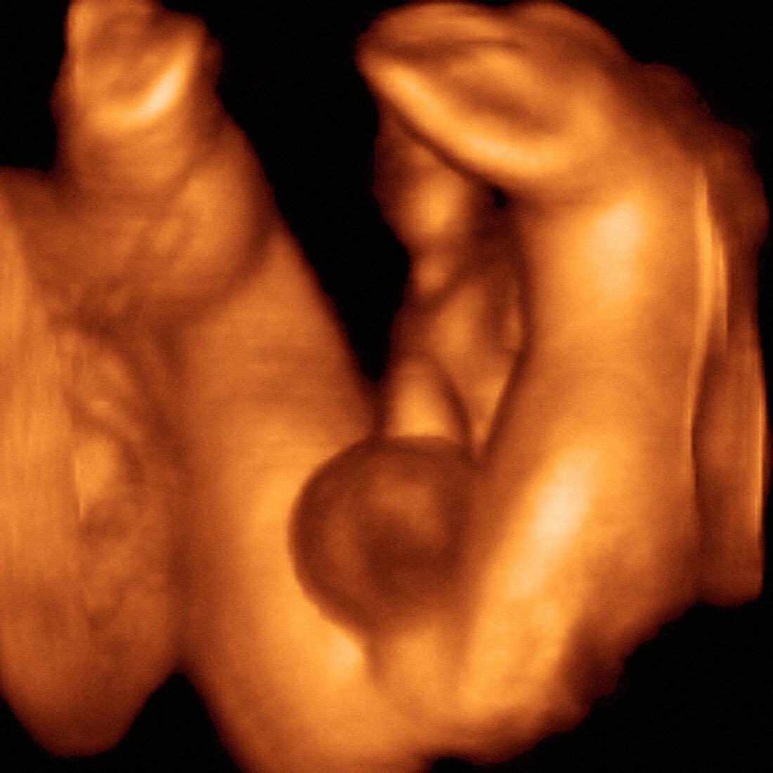 Foetal genitalia,3-D ultrasound scan