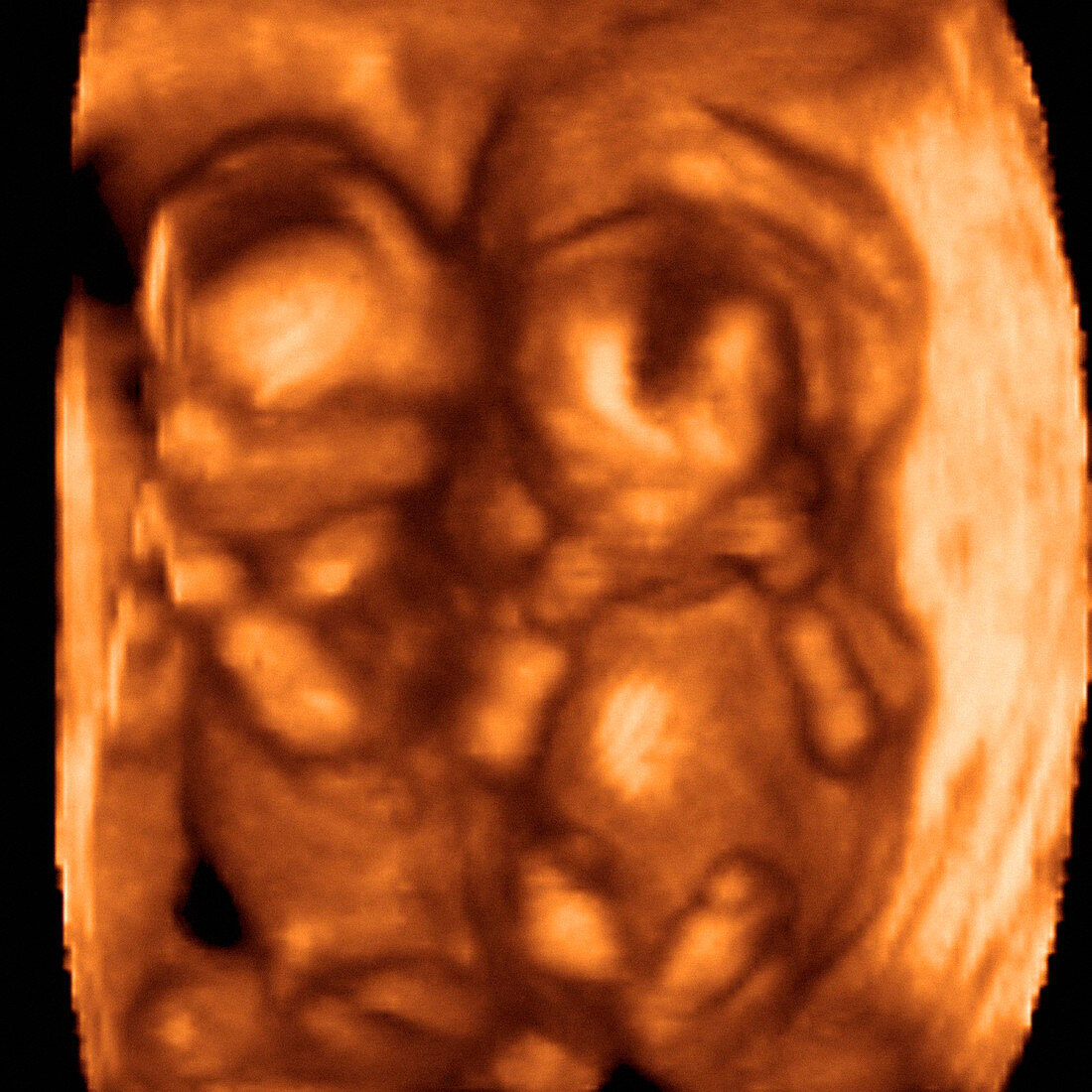 Twin foetuses,3-D ultrasound scan