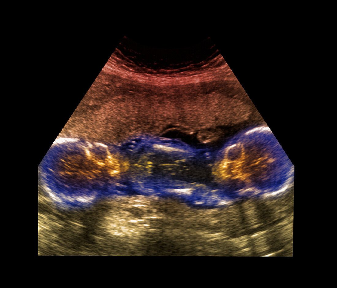 Twin foetuses,ultrasound