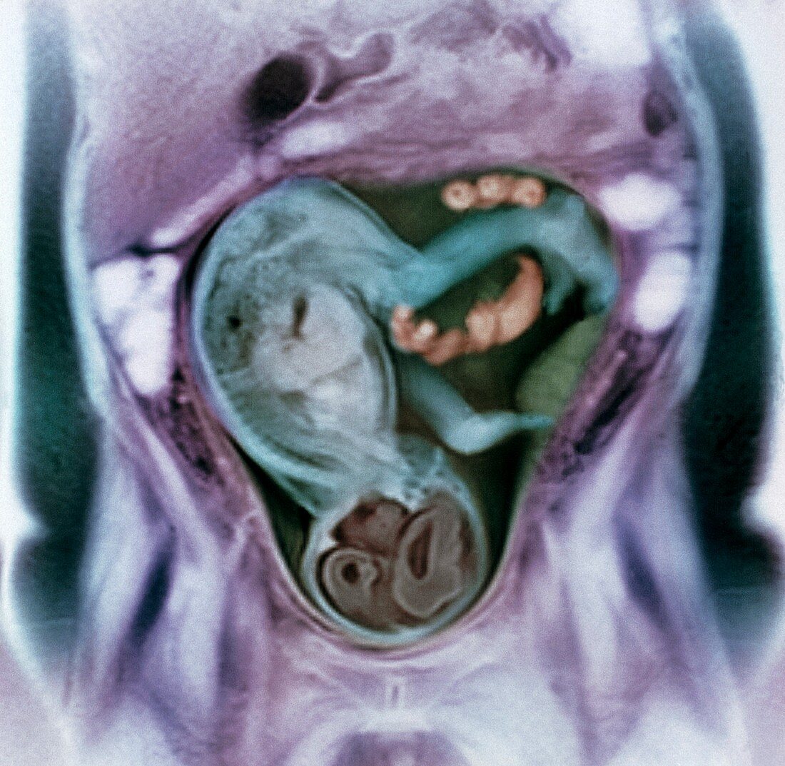 36 week foetus,MRI scan