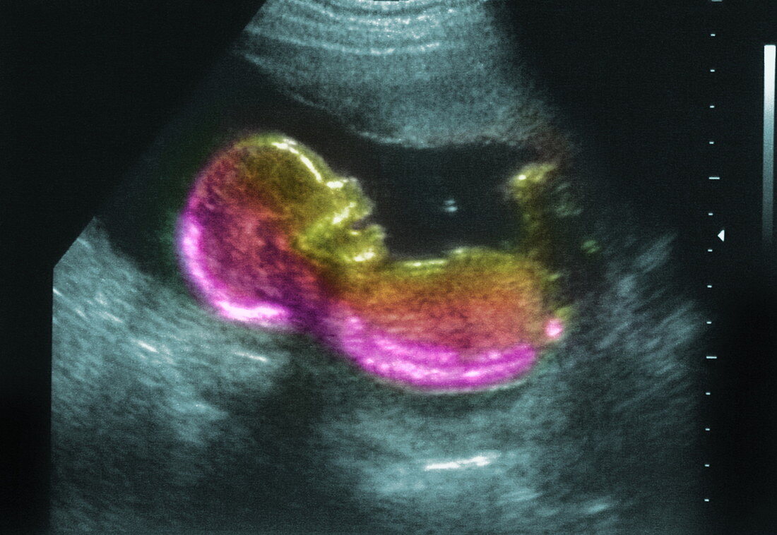 20 week foetus,ultrasound scan