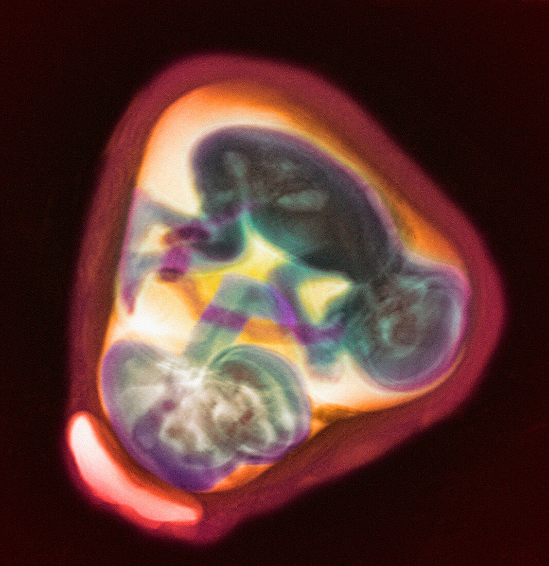 32 week twin foetuses,MRI scan