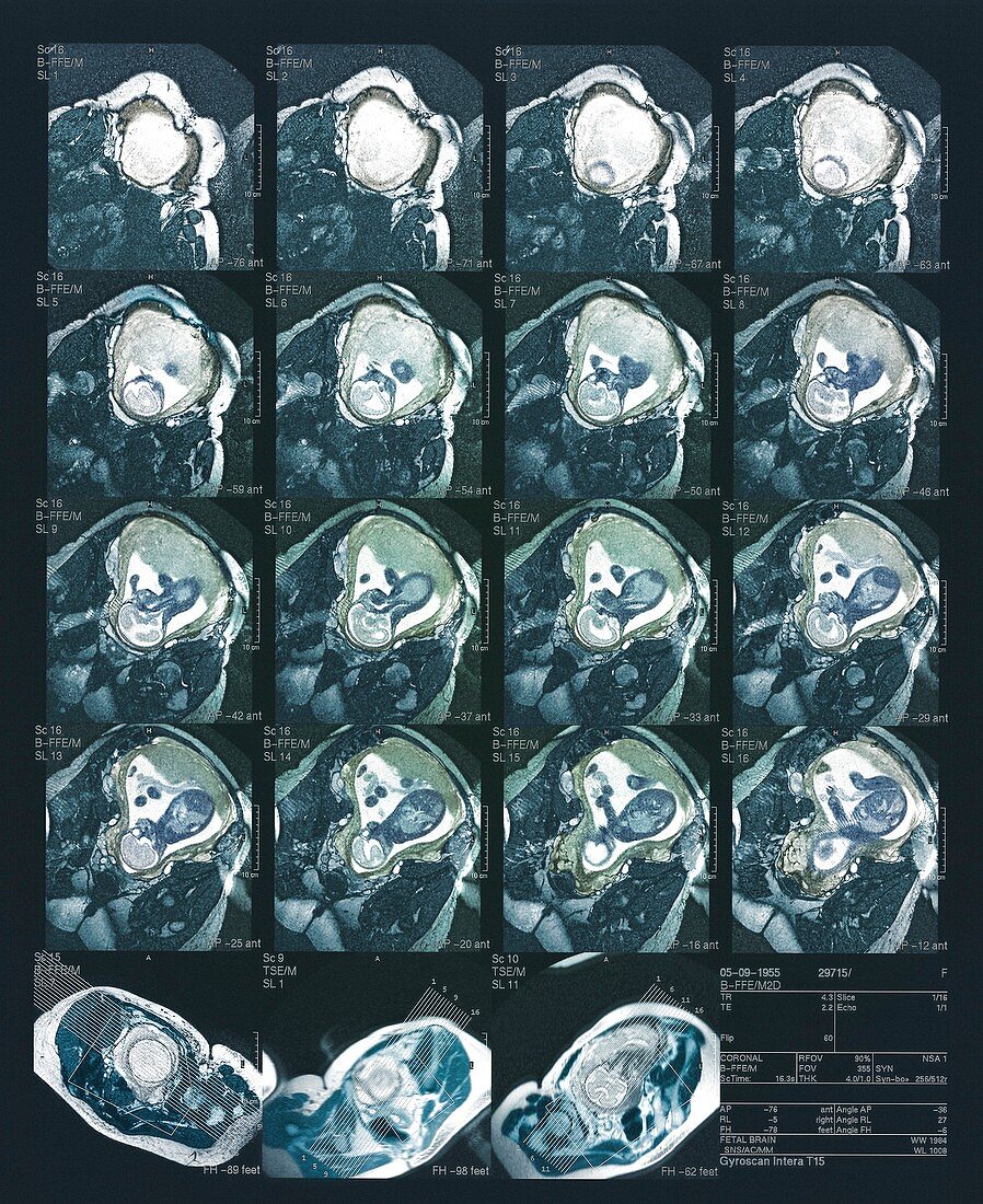 27 week foetus,MRI scans