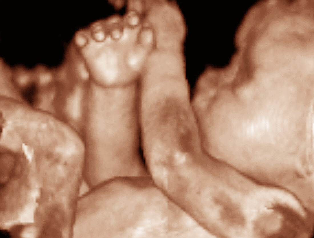 3-D foetal ultrasound