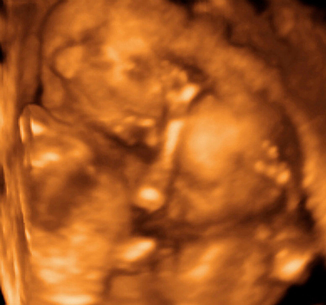 Twins,3-D ultrasound scan