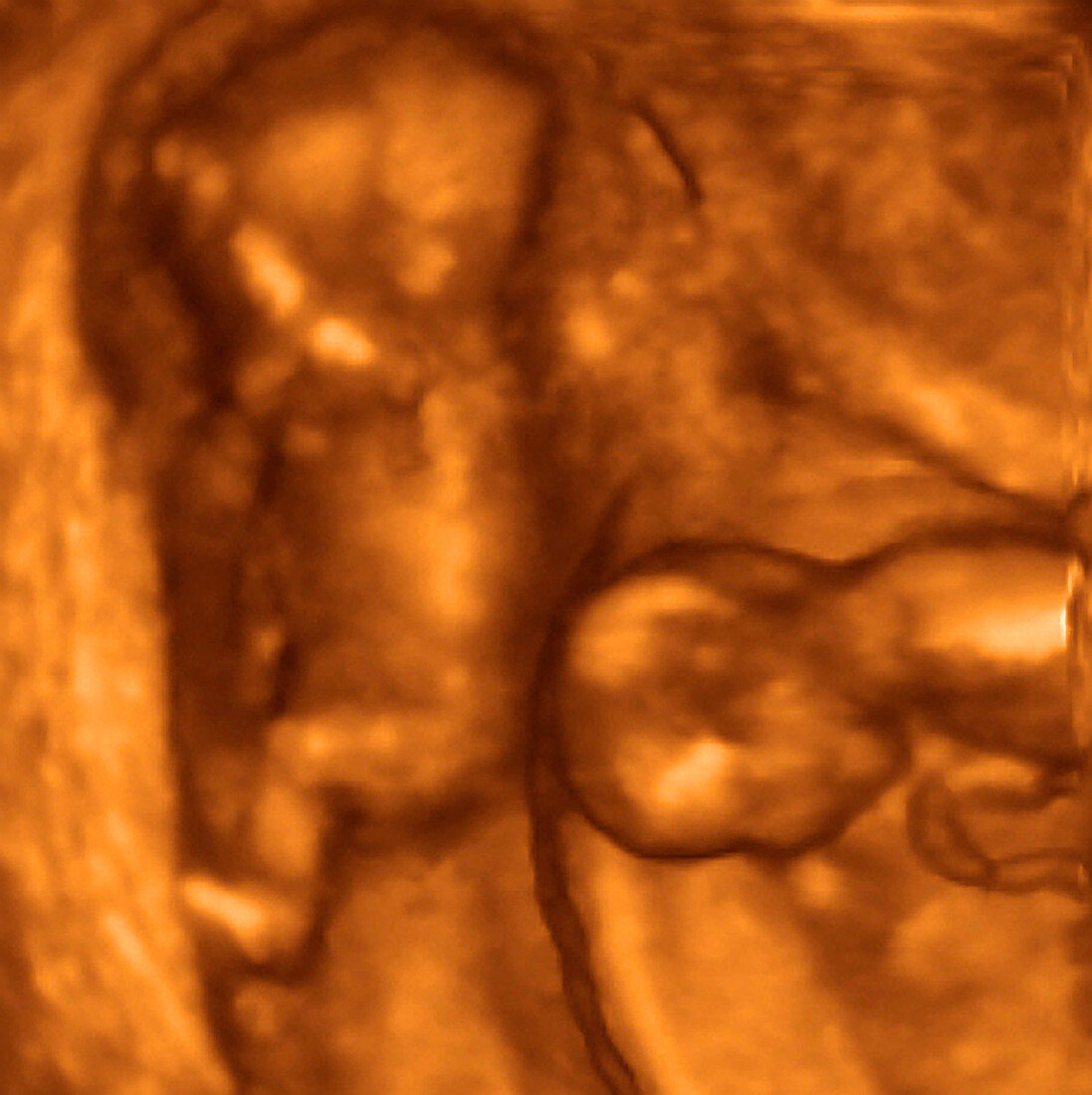 16 week twins,3-D ultrasound scan