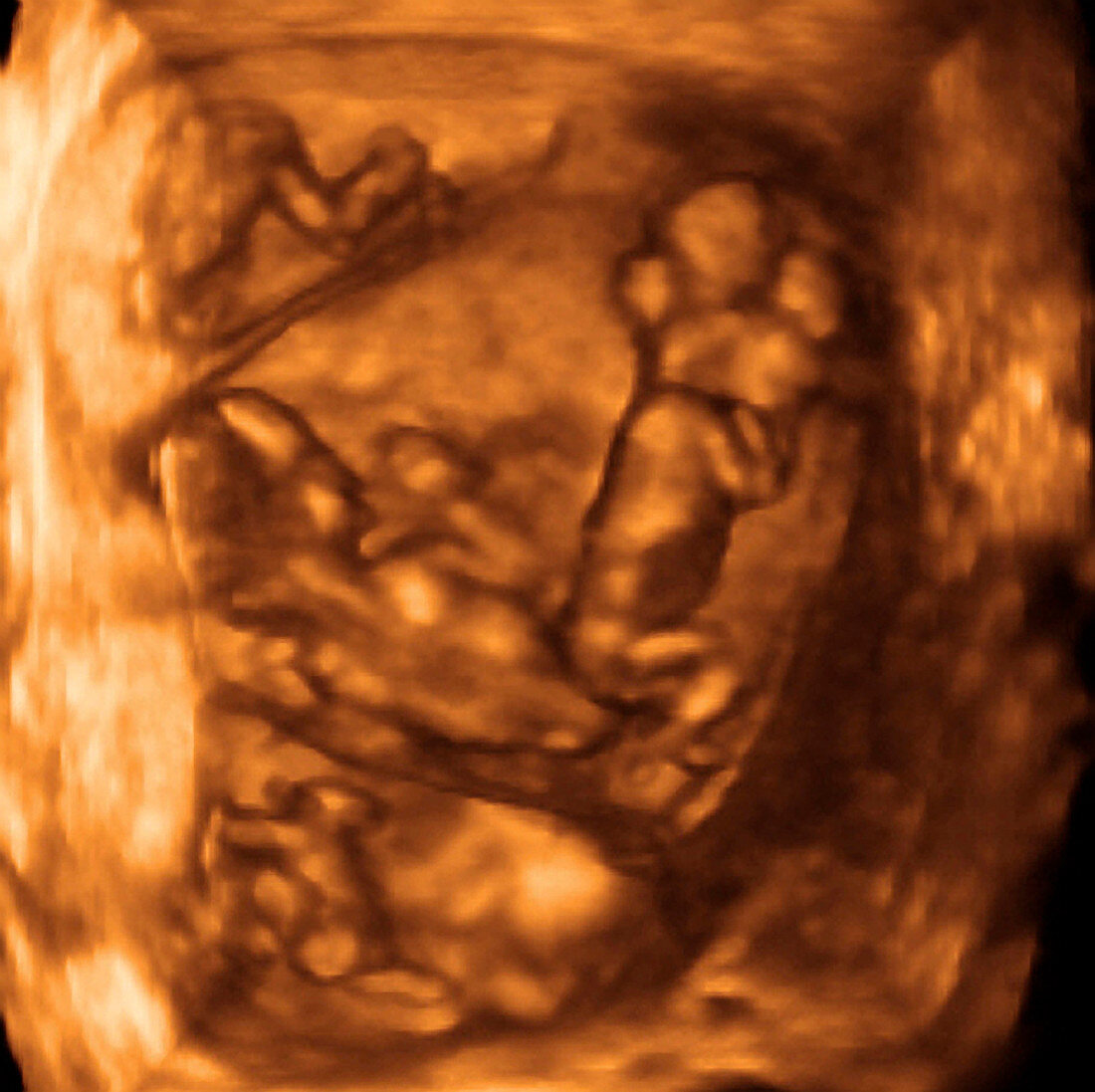 12 week quadruplets,4-D ultrasound scan