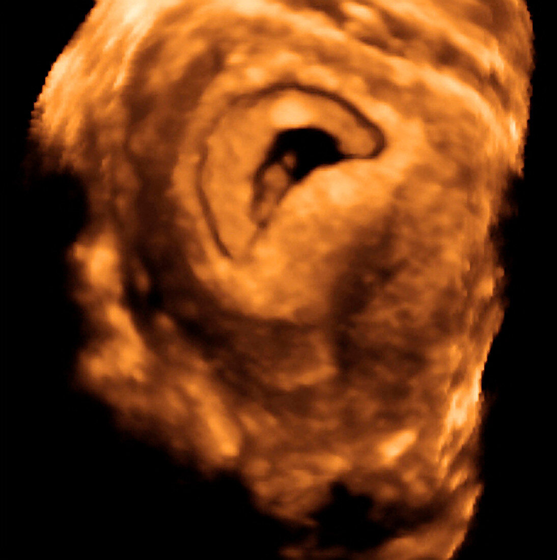 Embryo,3-D ultrasound scan