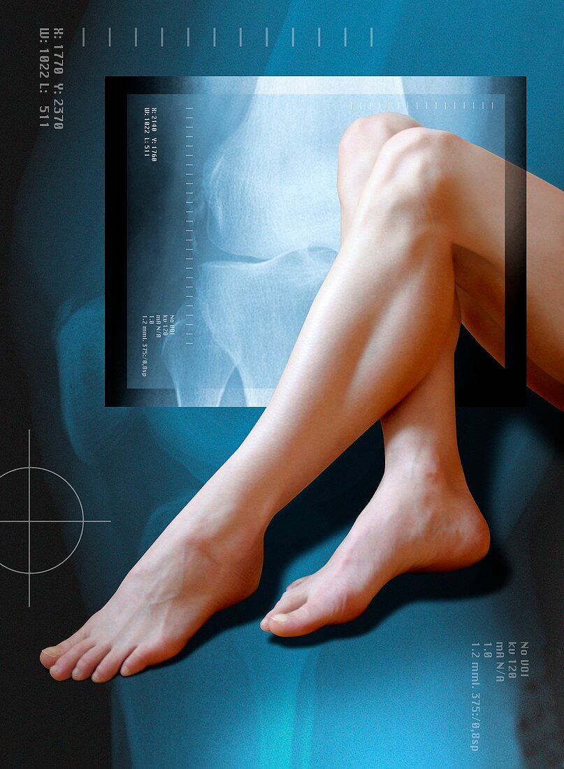 Woman's legs,with knee X-ray