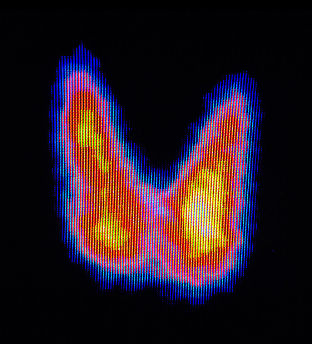 Coloured gamma scan of normal human thyroid gland