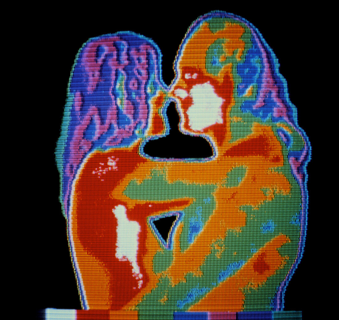 Thermogram of couple