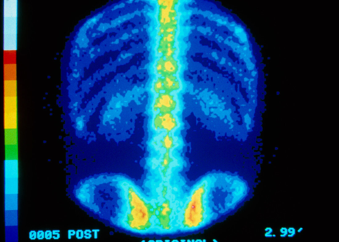 False-colour bone scintigram of a healthy adult
