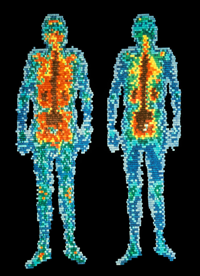 Scintigrams of healthy man,front & rear views