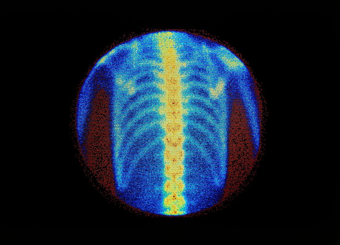 Normal bone scan of chest: posterior view