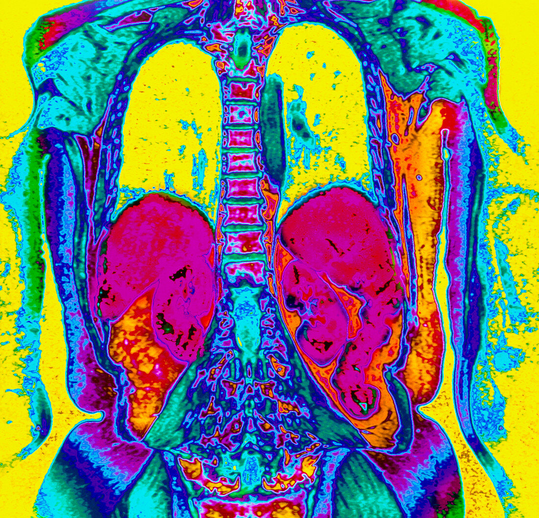 Col. MRI scan of thorax & abdomen of elderly woman