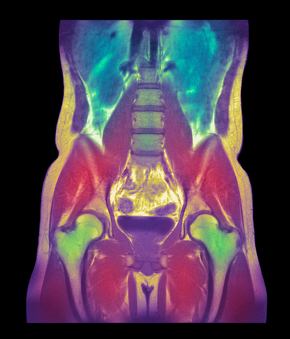 Abdominal scan,MRI