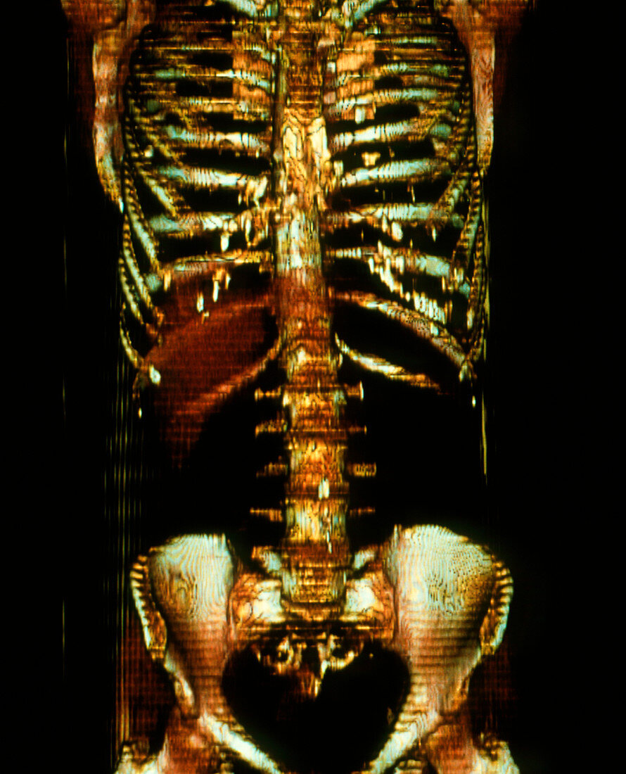 Thorax and abdomen,EBT scan