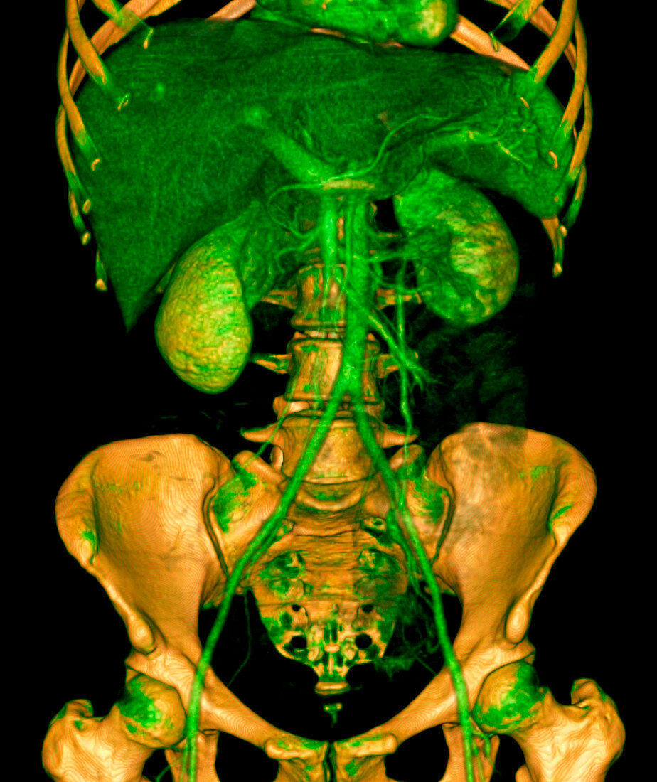 Abdomen,CT scan