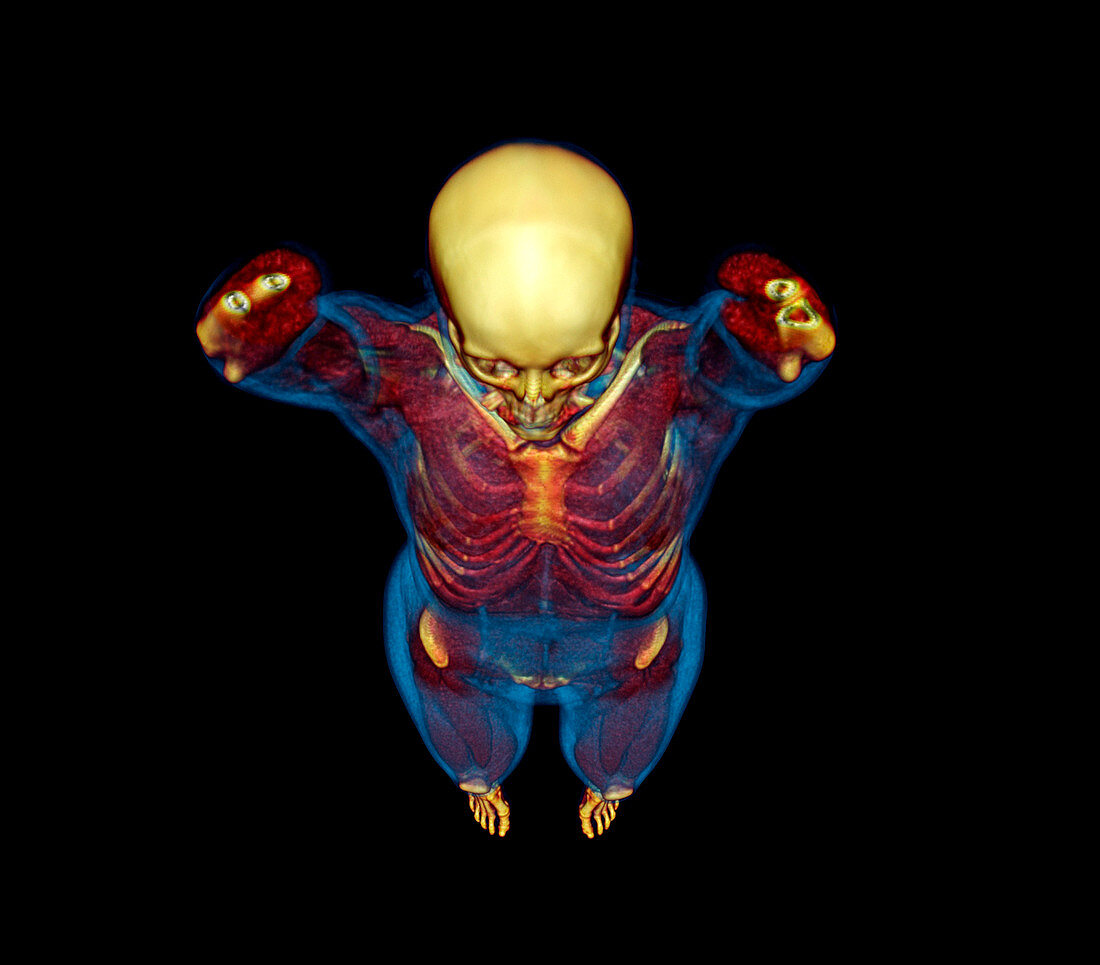 Female body,CT scan