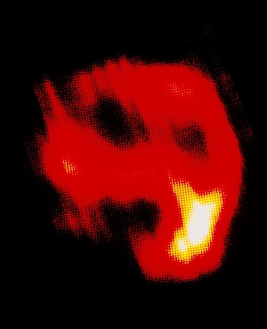 The supernova remnant MSH 11-54 seen in infrared