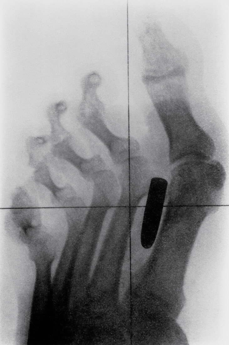X-ray of bullet in foot of Boer War soldier,1899