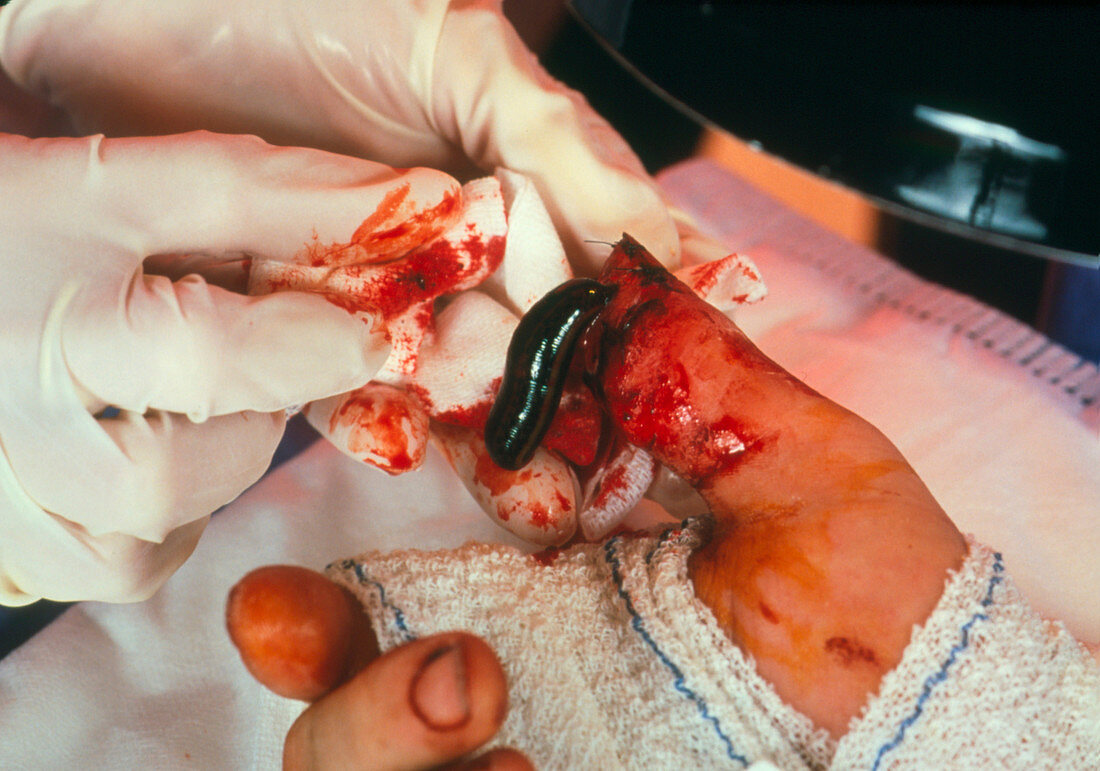 Leech (Hirudo medicinalis) on injured thumb