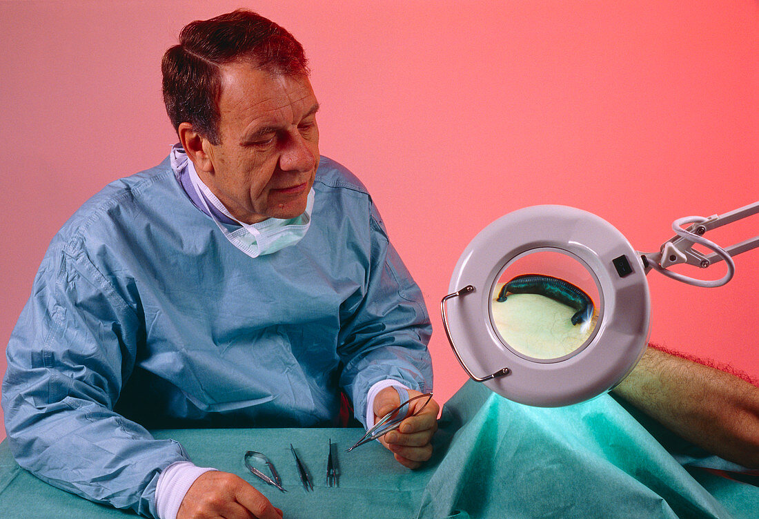 Surgeon using leech (Hirudo sp.) during operation