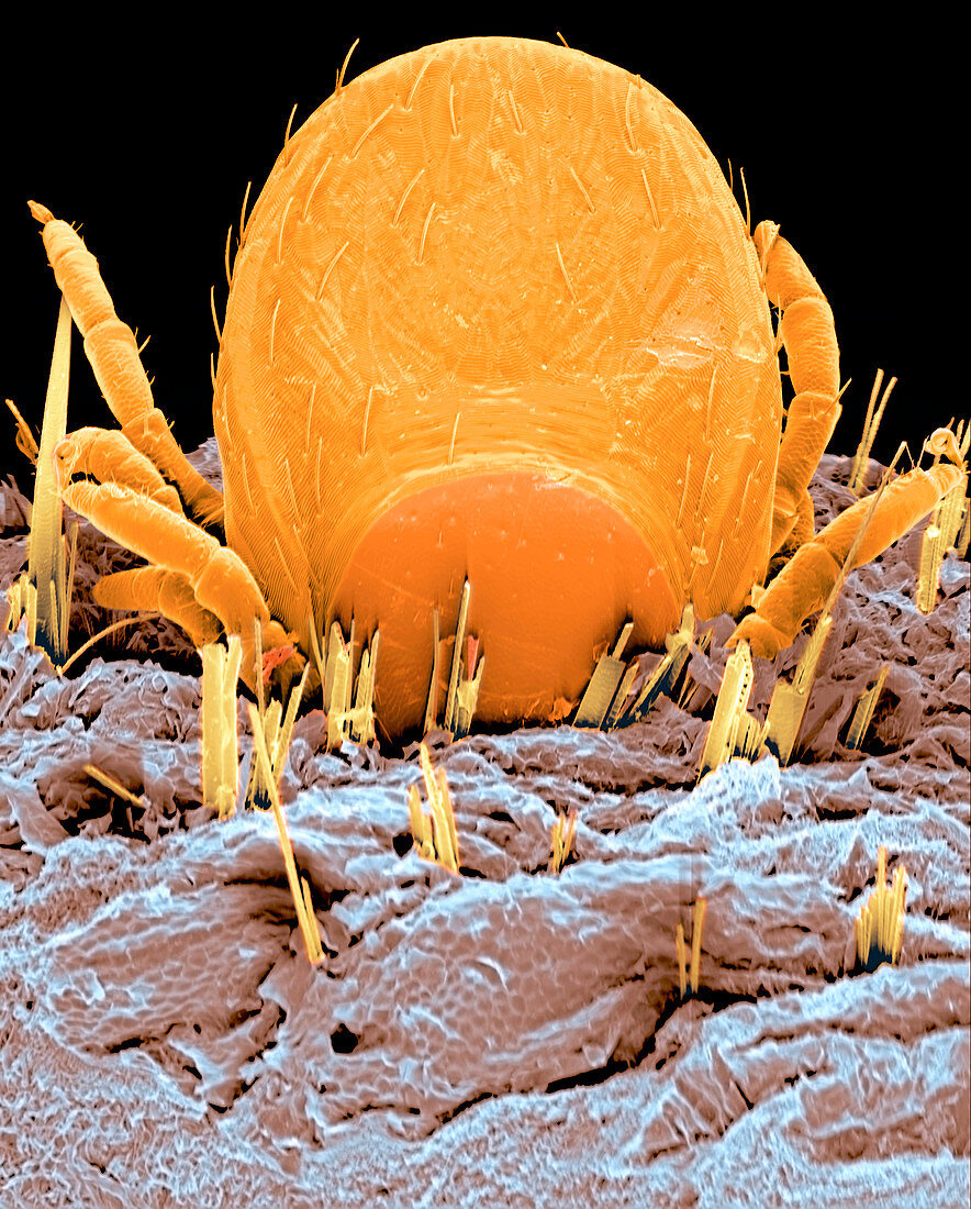 Coloured SEM of a tick (Ixodes sp.) in human skin