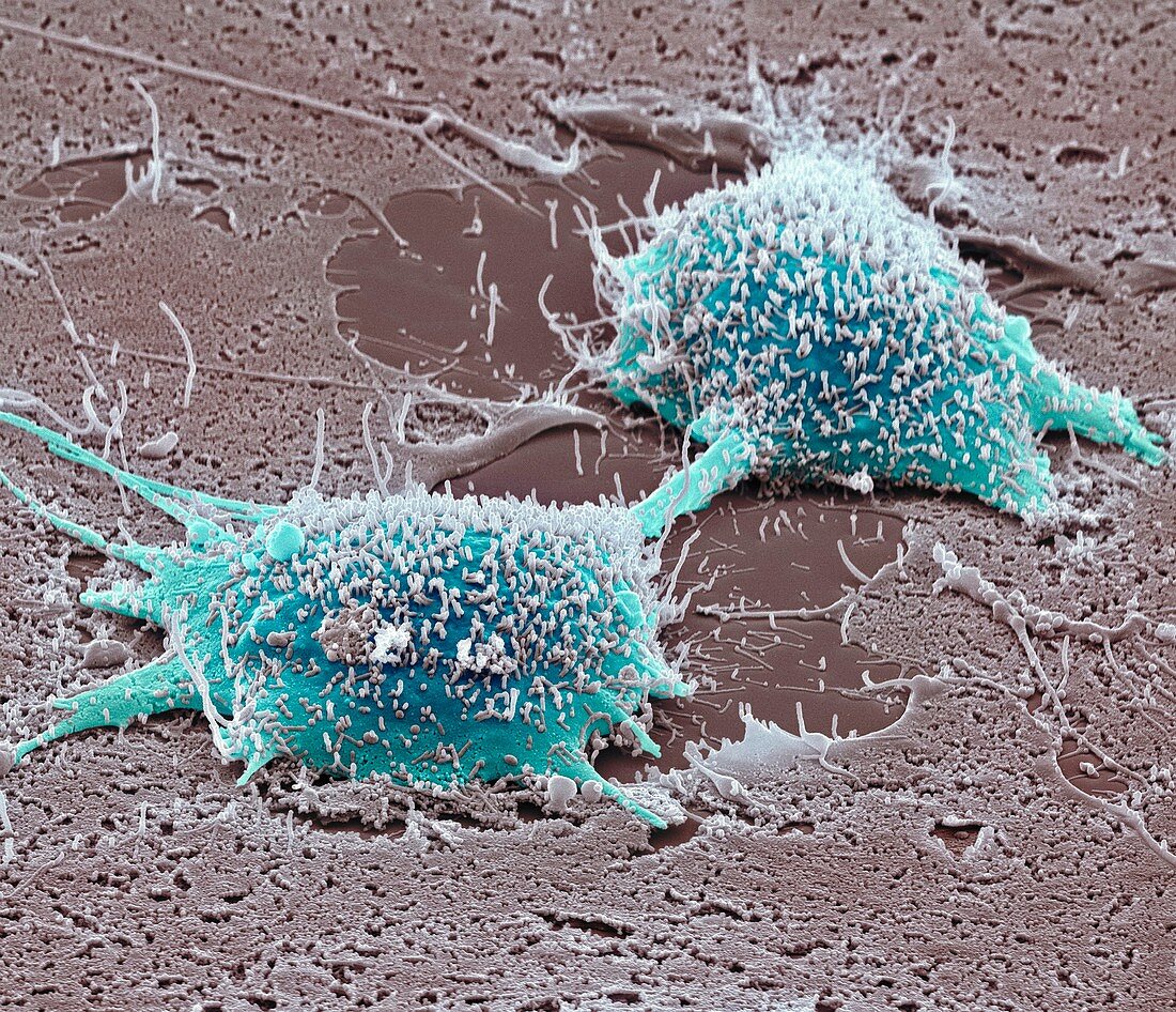 Dividing cancer cell,SEM