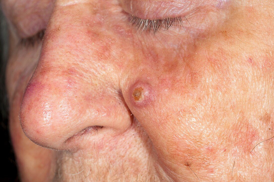 Basal cell skin cancer on the face