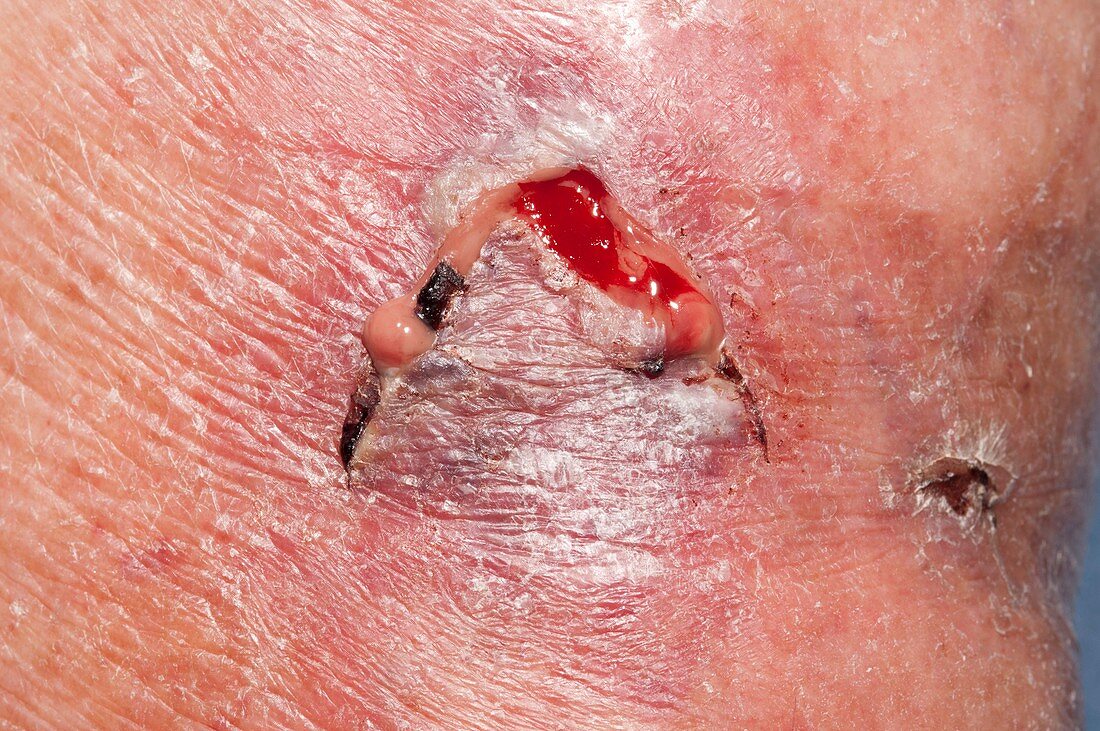 Infected flap laceration on the skin