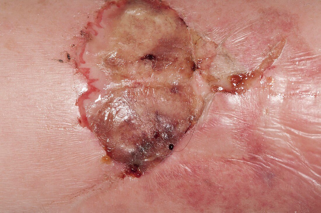 Infected blister on skin in diabetic