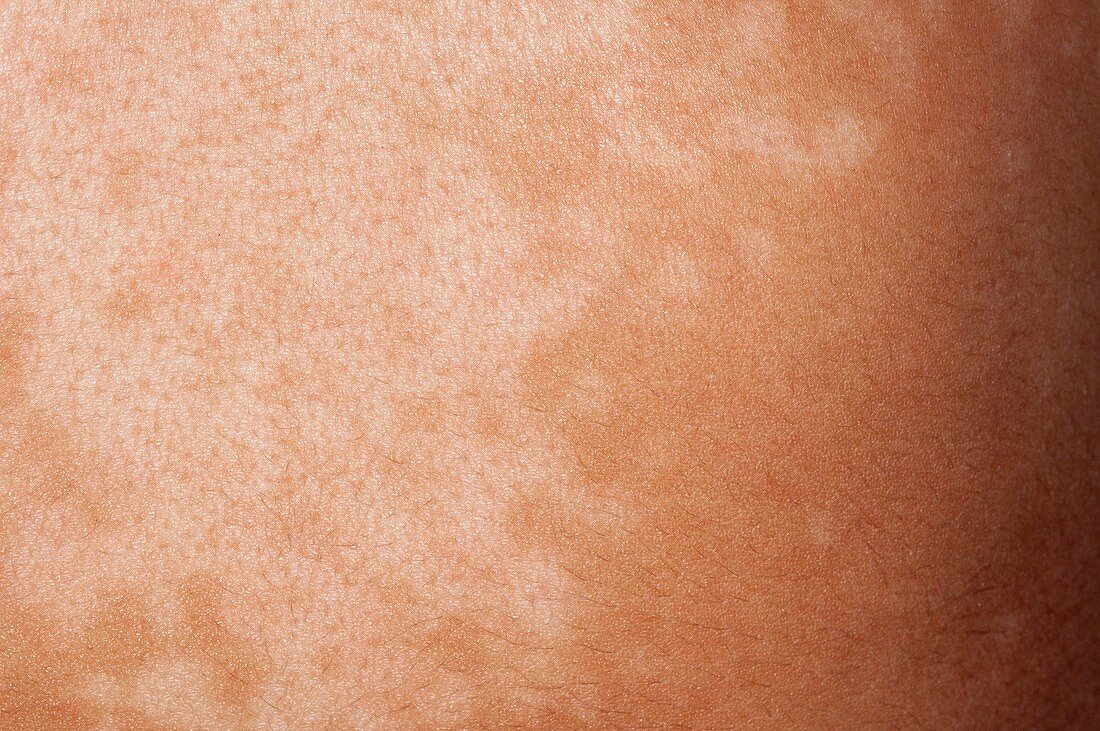 Pityriasis versicolor skin infection