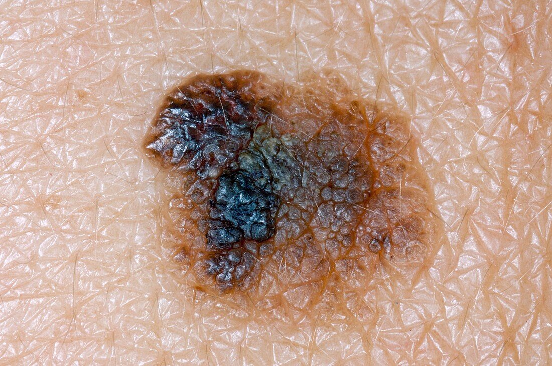 Seborrheic wart on the skin