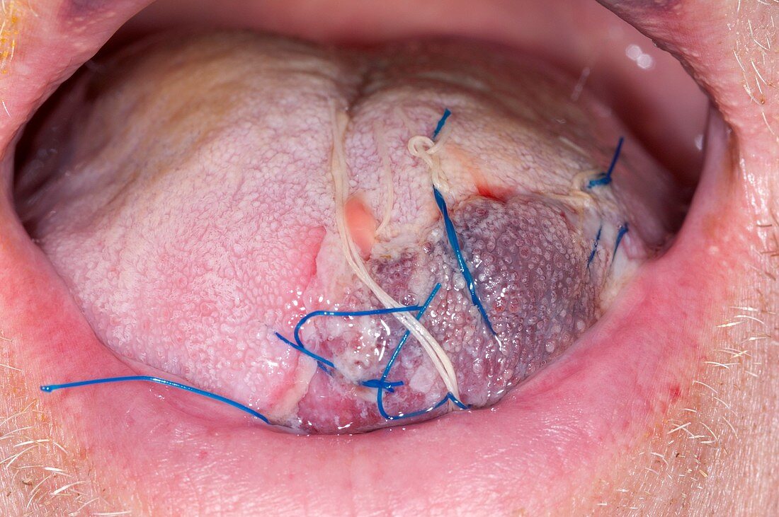 Sutured laceration of the tongue