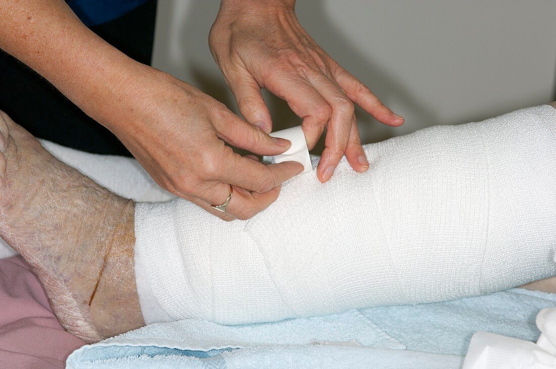 Leg ulcers dressed with a bandage