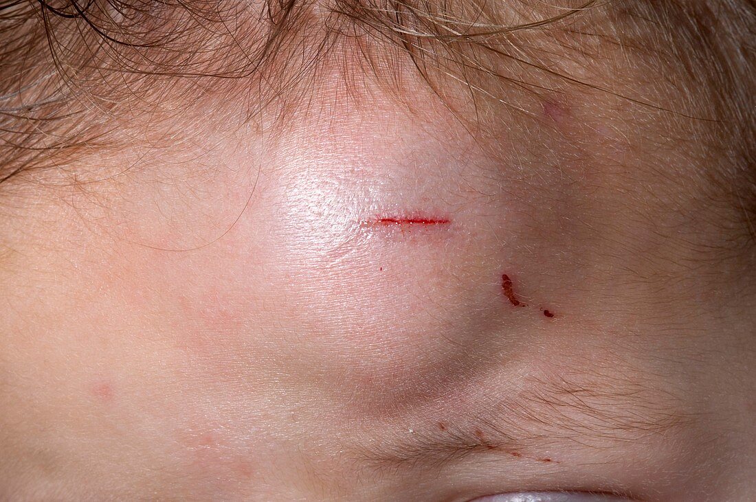 Bump on the head from an injury