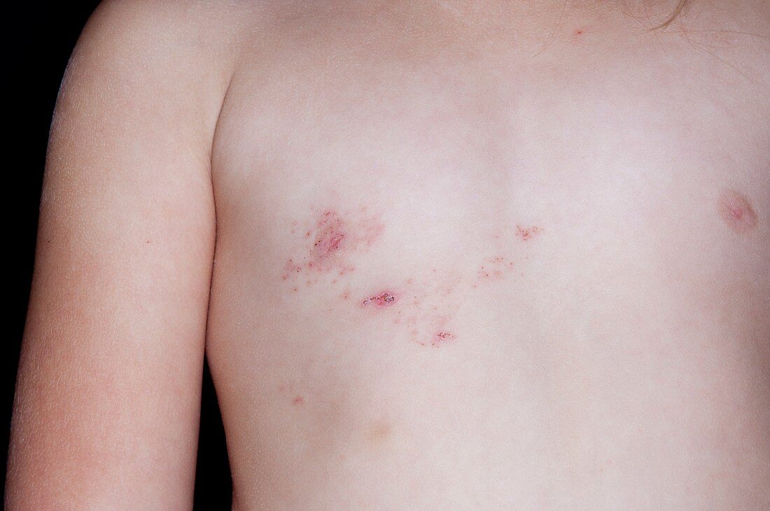Shingles rash on the chest
