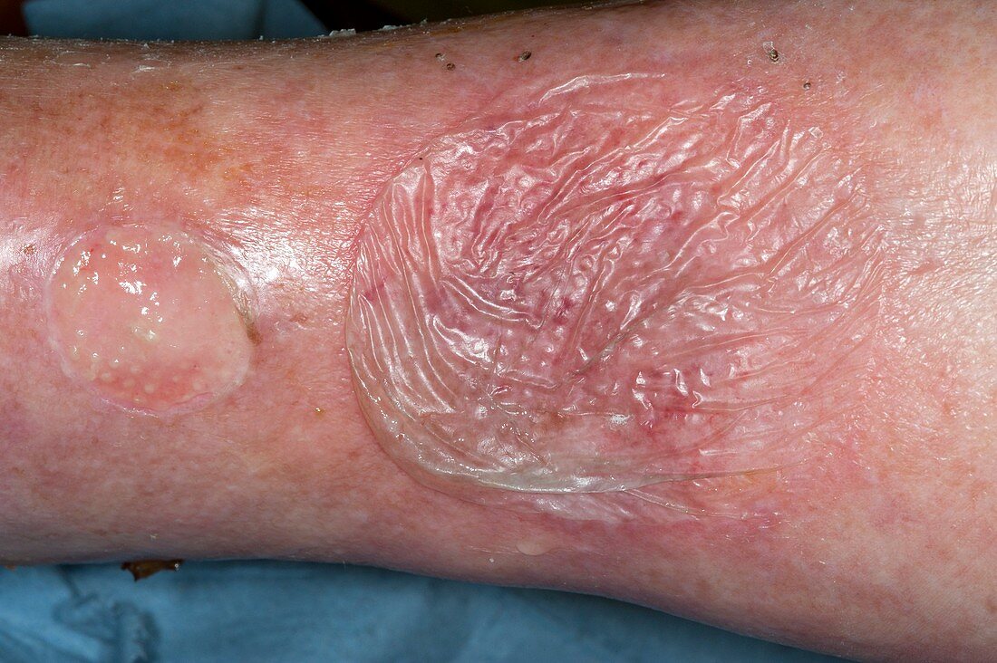 Skin blister from bacterial infection